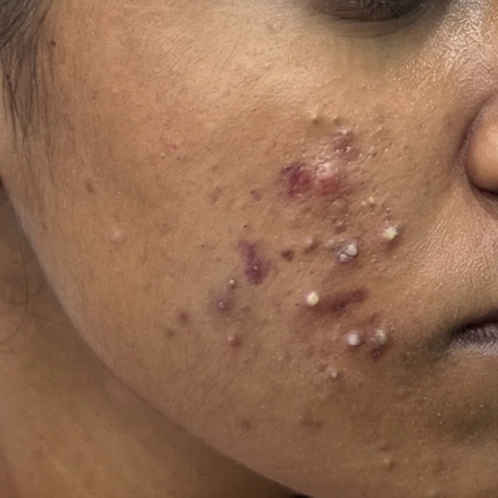 Acne Before
