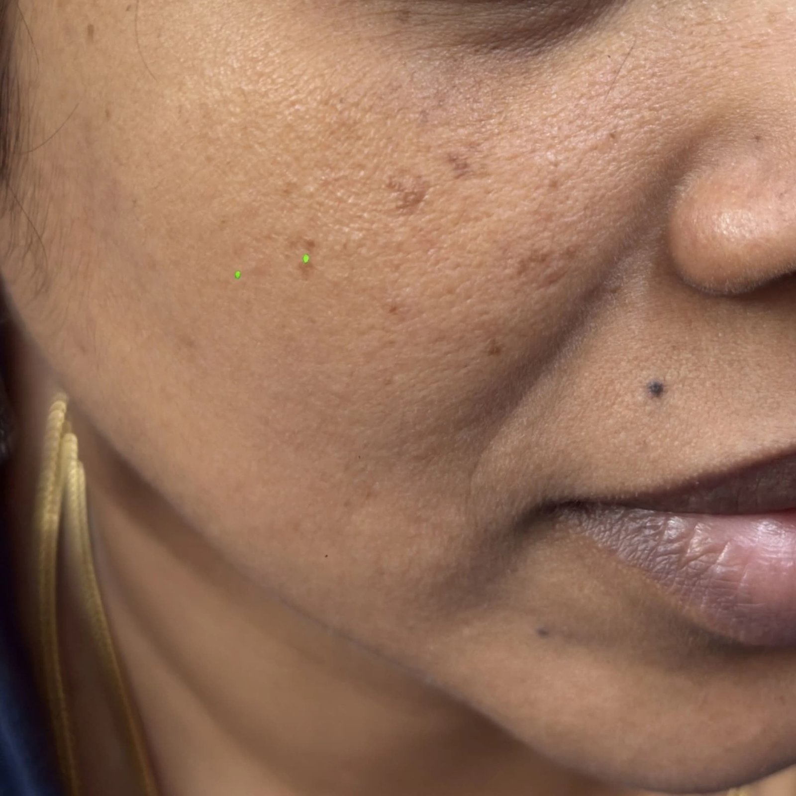 Pigmentation Patient 6 Before
