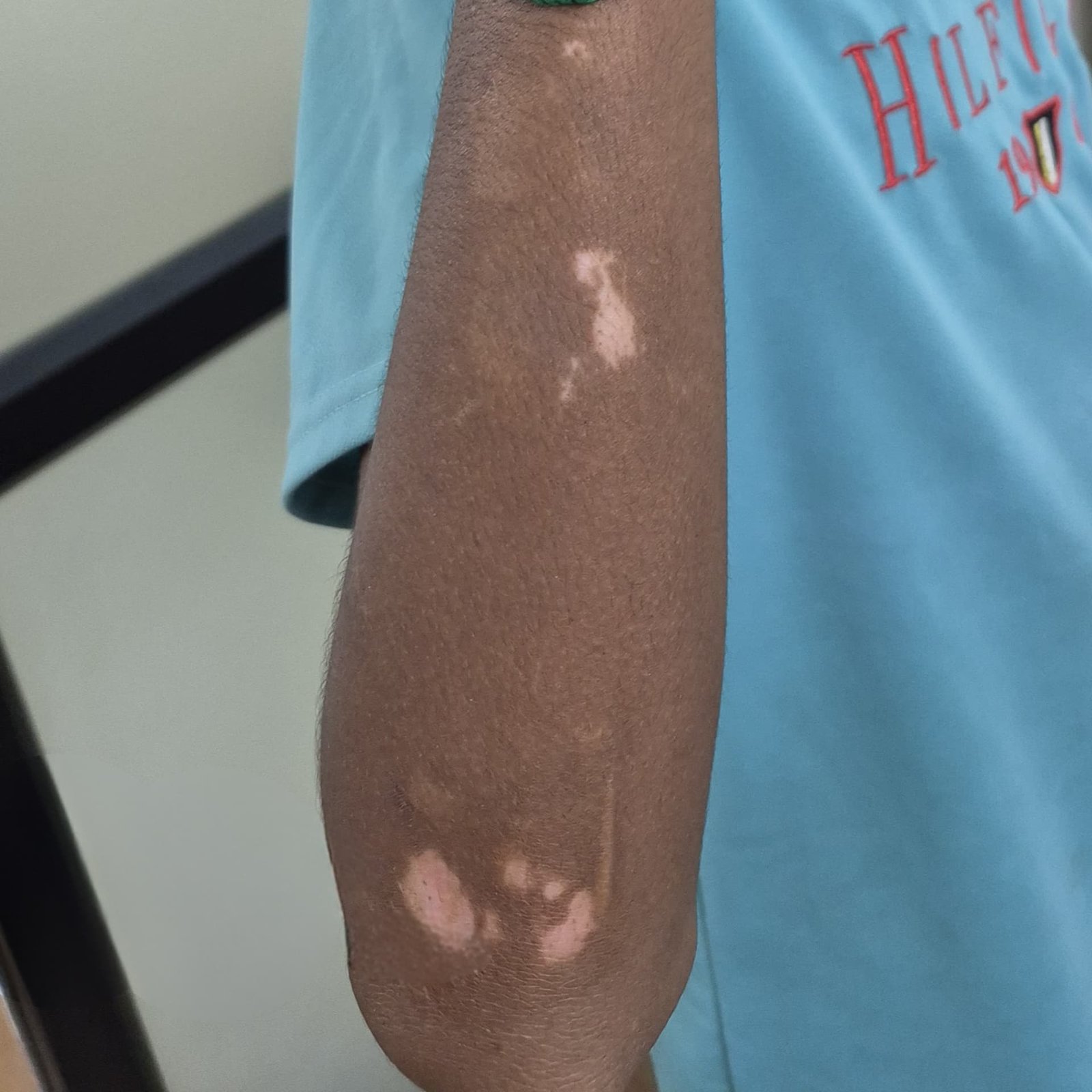 Vitiligo Patient 1 Before