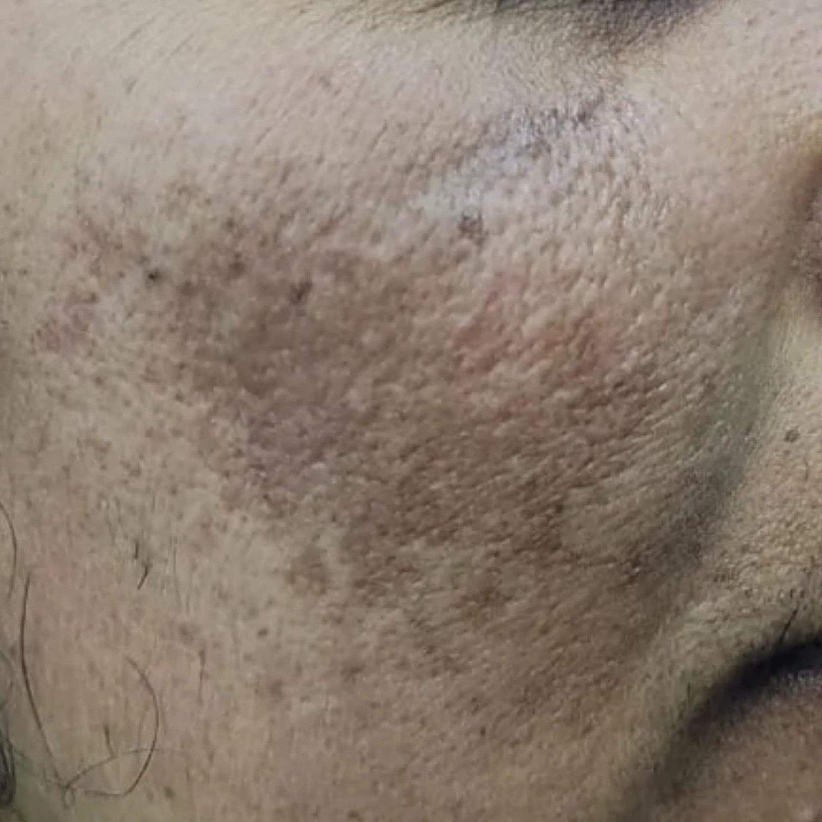 Pigmentation Before