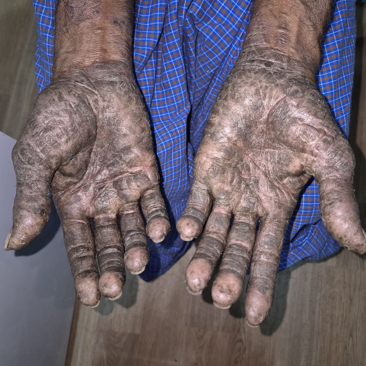 Psoriasis Before