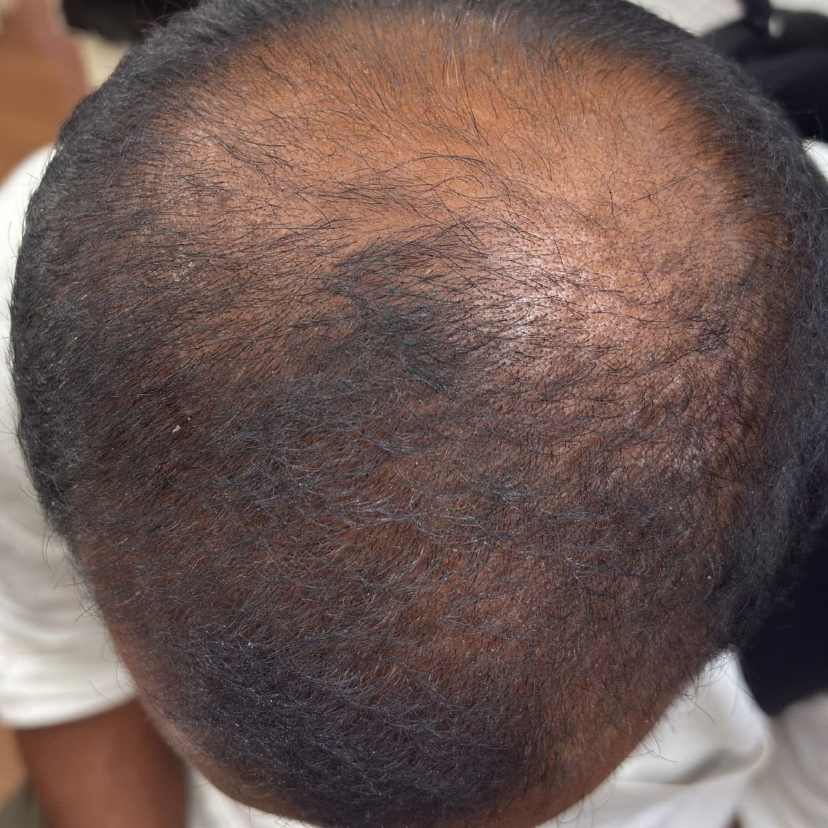 Hair Restoration Patient 4 After