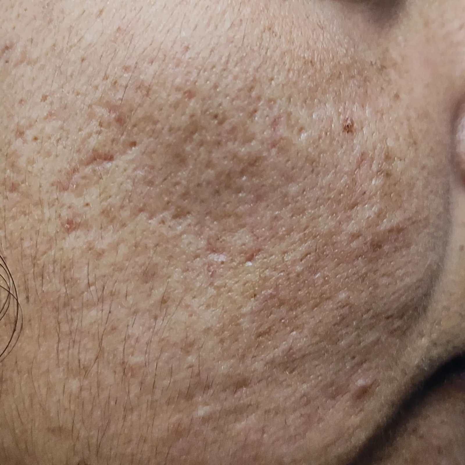 Pigmentation After