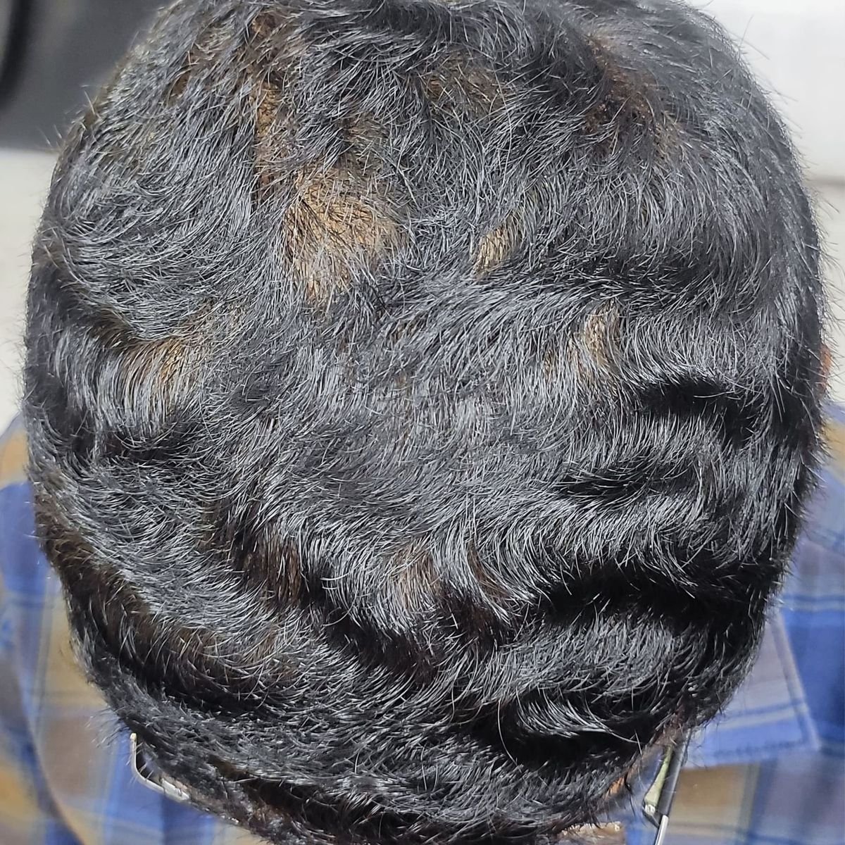 Hair Restoration Patient 5 After